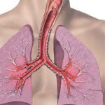 Bronchial Asthma – Upper Respiratory Infections